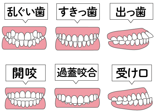 不揃いに生えた歯（乱ぐい歯）・すきっ歯・出っ歯・ポカン口（開咬）